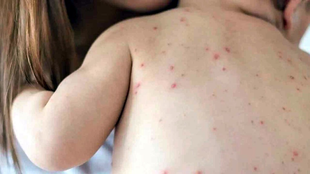 হাম ও উপসর্গ নিয়ে আরও ৭ শিশুর মৃত্যু