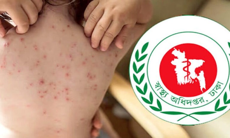 হাম ও হামের উপসর্গে শিশুর মৃত্যু ৫০০ ছাড়াল