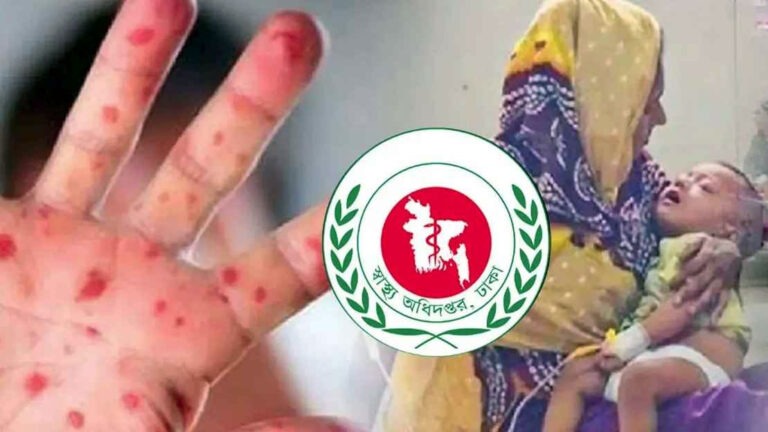 হাম উপসর্গে আরও ৭ শিশুর মৃত্যু