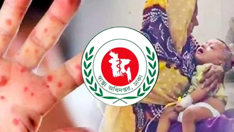 হামের উপসর্গে আরও ৫ শিশুর মৃত্যু